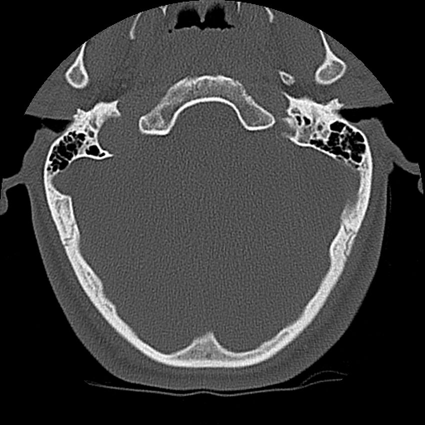 Cervical flexion teardrop fracture with cord hemorrhage (Radiopaedia 32497-33454 Axial bone window 2).jpg