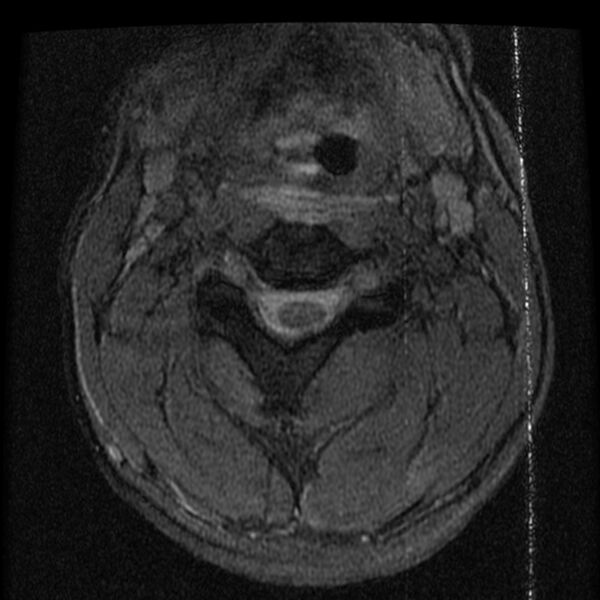 File:Cervical flexion teardrop fracture with cord hemorrhage (Radiopaedia 32497-33455 Axial Gradient Echo 7).jpg