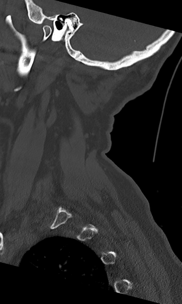 File:Cervical spine fracture - chalk stick (Radiopaedia 39116-41323 Sagittal bone window 9).png
