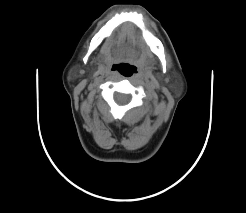 Cervical venous malformation (Radiopaedia 22653-22672 Axial non-contrast 25).jpg