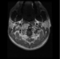 Cervical vertebrae metastasis (Radiopaedia 78814-91667 Axial T1 C+ 25).png