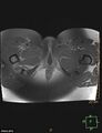 Cesarian scar endometriosis (Radiopaedia 68495-78066 Axial T1 C+ fat sat 29).jpg