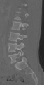 Chance fracture (Radiopaedia 40360-42912 Sagittal bone window 38).png