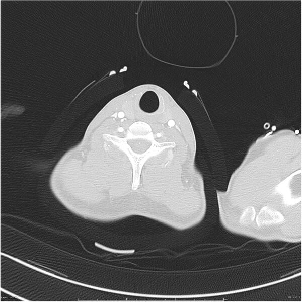File:Chest and abdomen multi-trauma (Radiopaedia 26294-26425 lung window 1).jpg