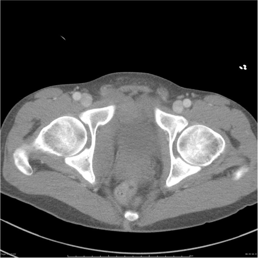 Chest and abdomen multi-trauma (Radiopaedia 26294-26426 A 85).jpg