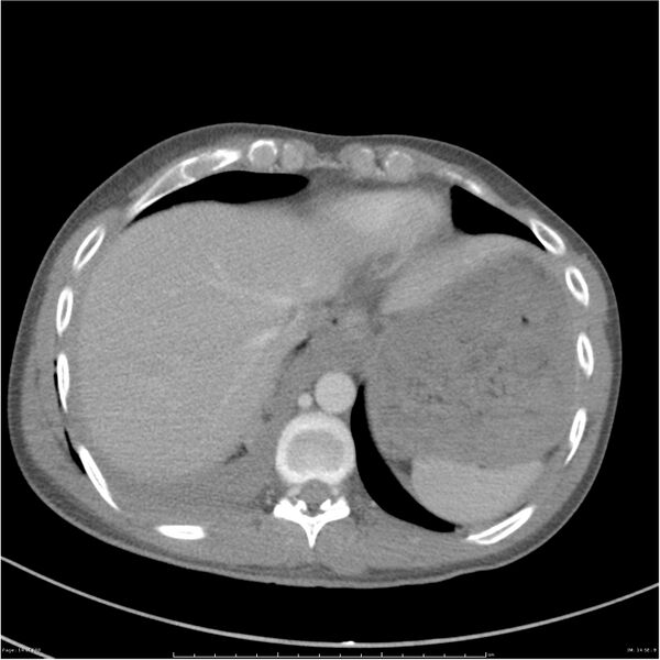 File:Chest and abdomen multi-trauma (Radiopaedia 26294-26426 bone window 14).jpg