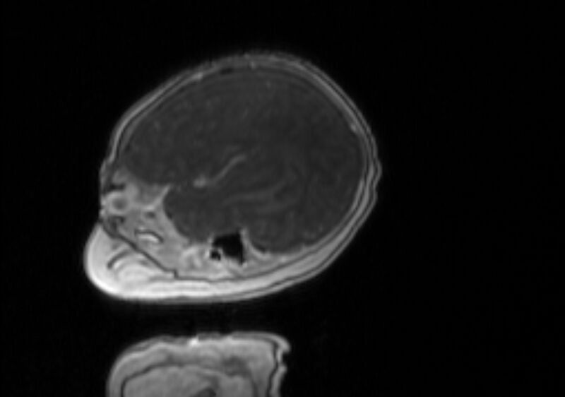 File:Chiari III malformation with occipital encephalocele (Radiopaedia 79446-92559 Sagittal T1 C+ mpr 52).jpg