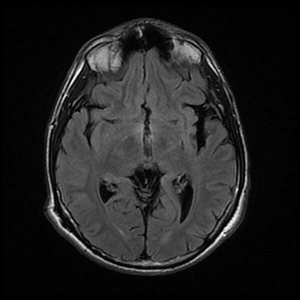 File:Chiasmatic-hypothalamic juvenile pilocytic astrocytoma (Radiopaedia 78533-91235 Axial FLAIR 14).jpg
