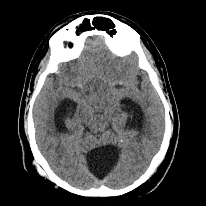 Chiasmatic-hypothalamic juvenile pilocytic astrocytoma (Radiopaedia 78533-91237 Axial non-contrast 24).jpg