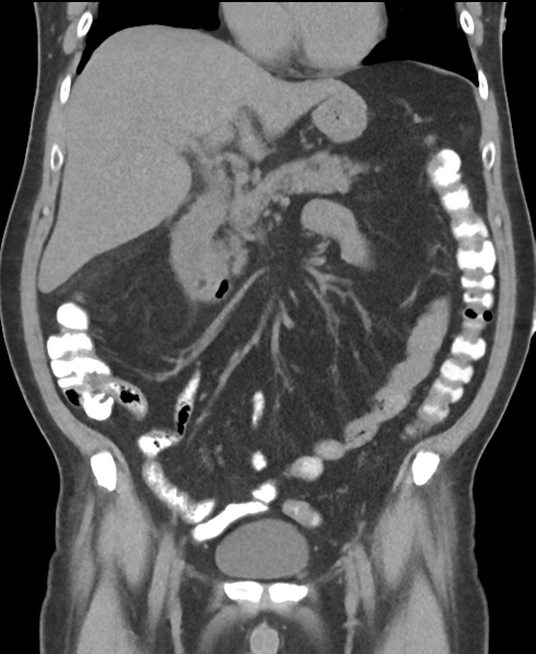File:Cholecystitis with focal perforation and hepatic abscess (Radiopaedia 37189-38945 Coronal non-contrast 25).png