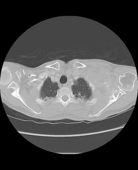 File:Chondrosarcoma (Radiopaedia 79427-92532 Axial lung window 7).jpg
