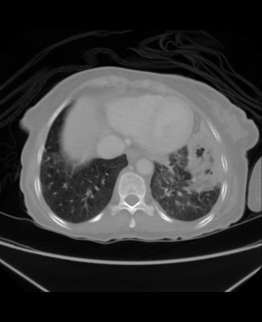 Chondrosarcoma (Radiopaedia 79427-92535 Axial lung window 41).jpg