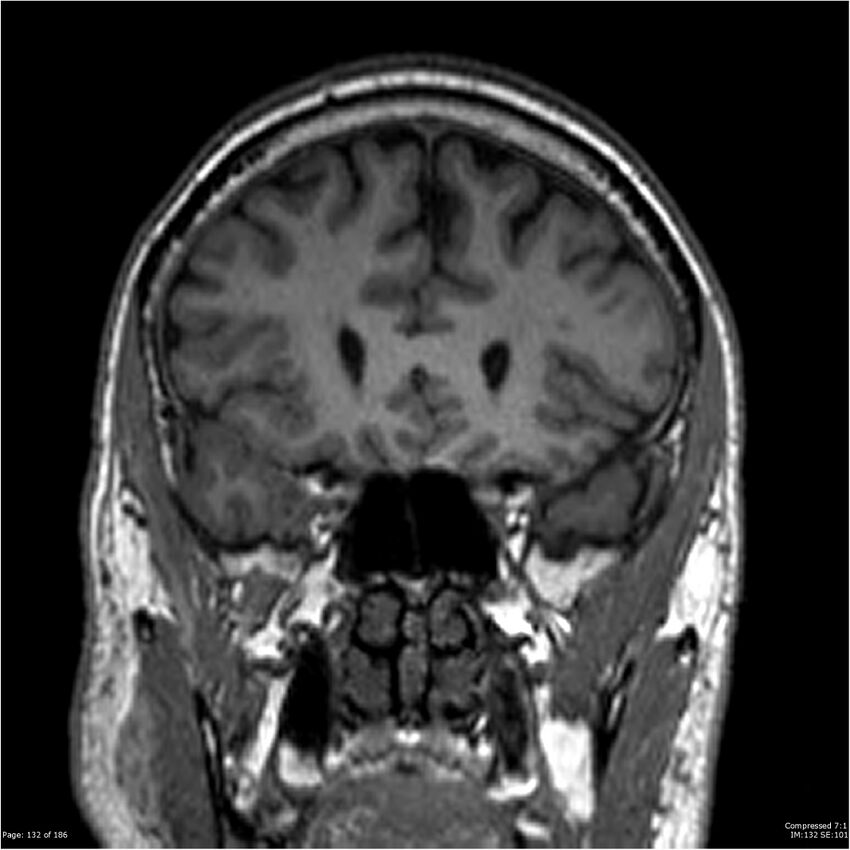 Chondrosarcoma of skull base- grade II (Radiopaedia 40948-43654 Coronal T1 53).jpg