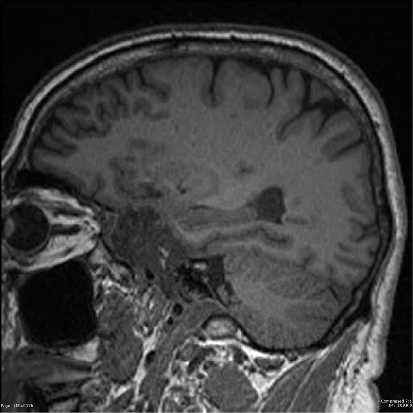 Chondrosarcoma of skull base- grade II (Radiopaedia 40948-43654 Sagittal T1 41).jpg