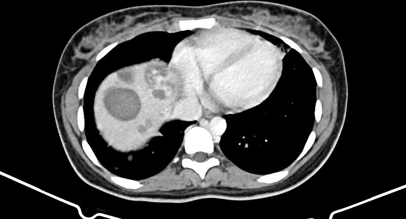 File:Choriocarcinoma liver metastases (Radiopaedia 74768-85766 A 19).jpg