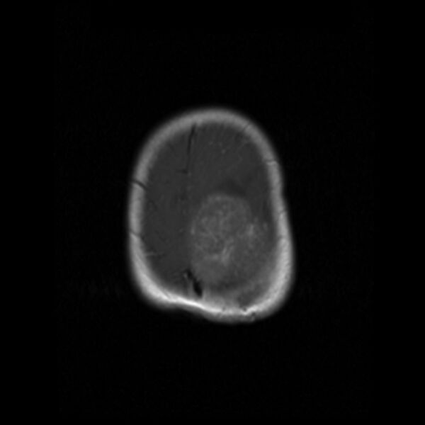File:Choroid plexus carcinoma (Radiopaedia 21121-21035 Axial T1 C+ 18).jpg