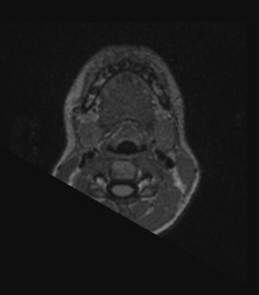 File:Choroid plexus carcinoma (Radiopaedia 91013-108553 Axial FLAIR C+ 20).jpg