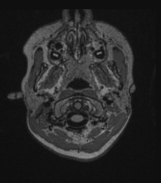 File:Choroid plexus carcinoma (Radiopaedia 91013-108553 Axial FLAIR C+ 62).jpg
