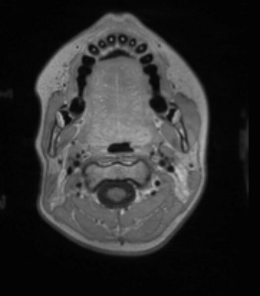 File:Choroid plexus carcinoma (Radiopaedia 91013-108553 Axial T1 C+ 46).jpg