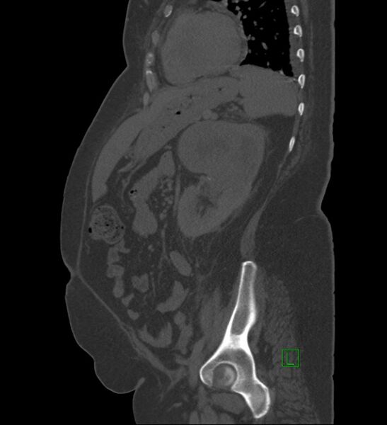 File:Chromophobe renal cell carcinoma (Radiopaedia 84239-99519 Sagittal bone window 33).jpg