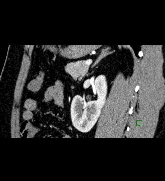 File:Chromophobe renal cell carcinoma (Radiopaedia 84286-99573 F 58).jpg