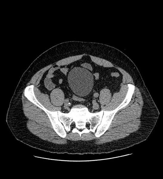 File:Chromophobe renal cell carcinoma (Radiopaedia 84337-99693 Axial non-contrast 122).jpg