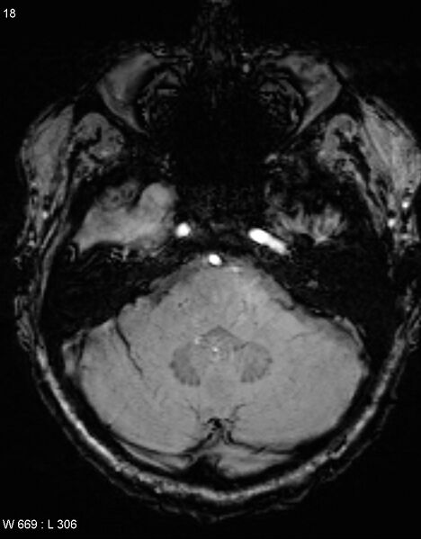 File:Chronic lymphocytic inflammation with pontine perivascular enhancement responsive to steroids (CLIPPERS) (Radiopaedia 37520-39374 Axial SWI 17).jpg