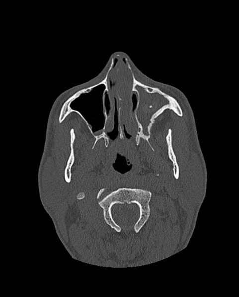 File:Chronic maxillary sinusitis caused by a foreign body (Radiopaedia 58521-65676 Axial bone window 104).jpg