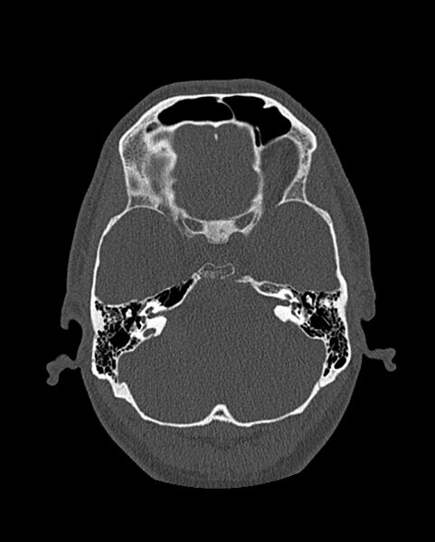 File:Chronic maxillary sinusitis caused by a foreign body (Radiopaedia 58521-65676 Axial bone window 254).jpg