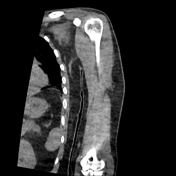 File:Chronic osteomyelitis (Radiopaedia 67597-76998 Coronal Soft tissue 4).jpg