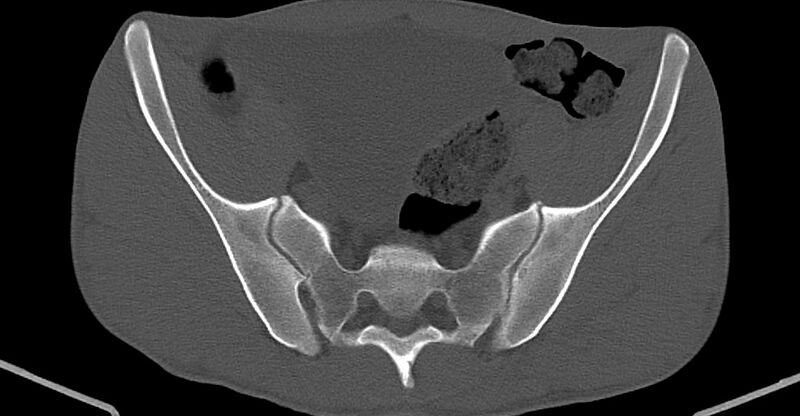 File:Chronic osteomyelitis (with sequestrum) (Radiopaedia 74813-85822 Axial non-contrast 11).jpg