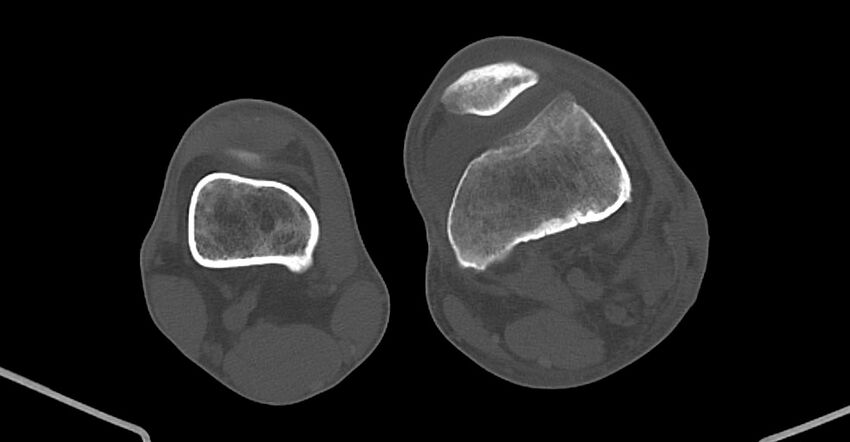 Chronic osteomyelitis (with sequestrum) (Radiopaedia 74813-85822 Axial non-contrast 175).jpg