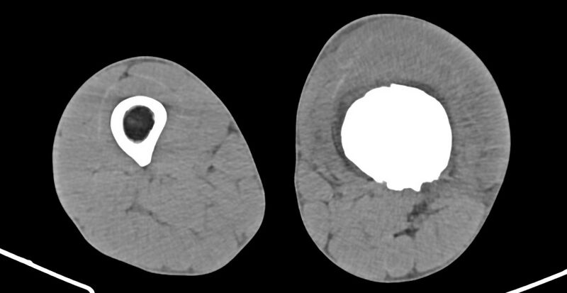 File:Chronic osteomyelitis (with sequestrum) (Radiopaedia 74813-85822 D 128).jpg