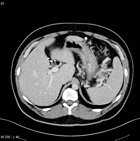 File:Chronic pancreatitis and pseudocysts (Radiopaedia 6724-7935 D 1).jpg