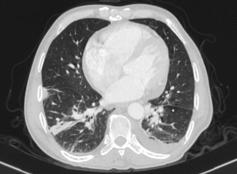 File:Chronic pulmonary embolism with bubbly consolidation (Radiopaedia 91248-108850 Axial lung window 106).jpg