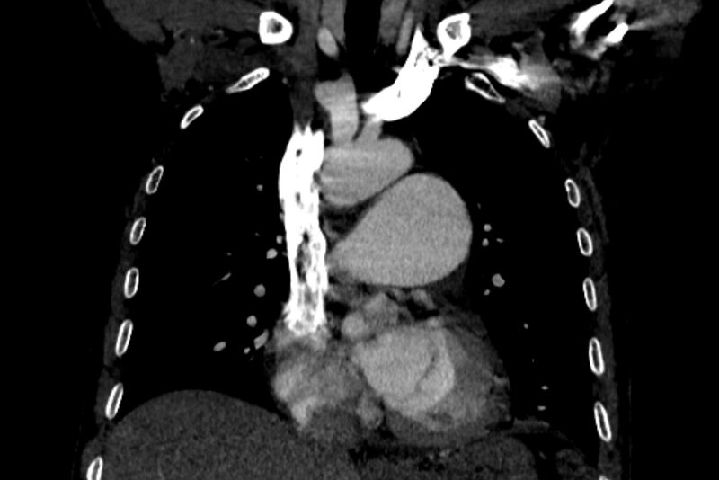File:Chronic pulmonary embolism with bubbly consolidation (Radiopaedia 91248-108850 B 61).jpg