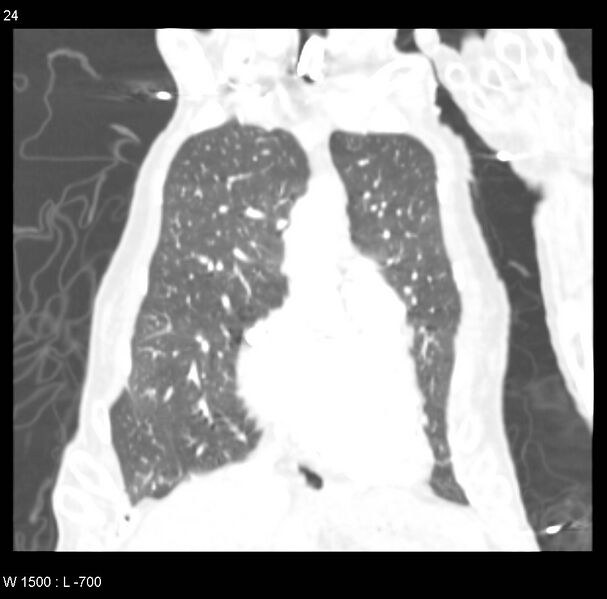 File:Clagett thoracotomy (Radiopaedia 8568-9403 Coronal lung window 24).jpg