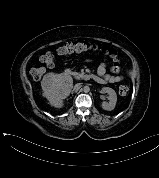 File:Clear cell renal cell carcinoma (Radiopaedia 85004-100537 Axial non-contrast 11).jpg
