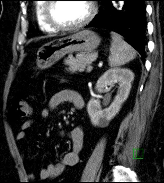 File:Clear cell renal cell carcinoma (Radiopaedia 85004-100537 D 21).jpg