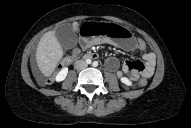 File:Closed loop small bowel obstruction (Radiopaedia 71211-81508 A 64).jpg