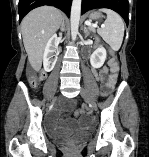 File:Closed loop small bowel obstruction (Radiopaedia 71211-81508 B 73).jpg