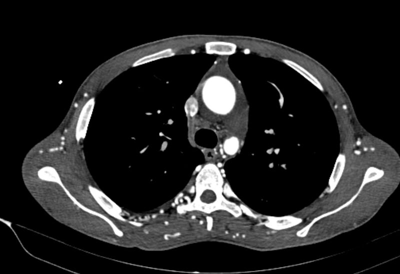 File:Coarctation of aorta with aortic valve stenosis (Radiopaedia 70463-80574 A 52).jpg