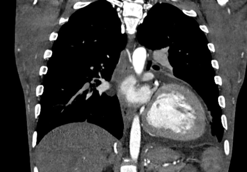 File:Coarctation of aorta with aortic valve stenosis (Radiopaedia 70463-80574 C 153).jpg