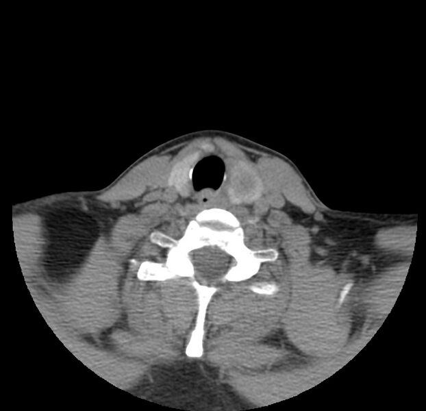 File:Colloid cyst of thyroid (Radiopaedia 22897-22923 Axial non-contrast 40).jpg
