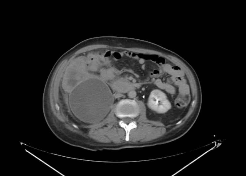 File:Colon cancer mimicking renal cell carcinoma (Radiopaedia 28986-29335 Axial C+ delayed 36).jpg