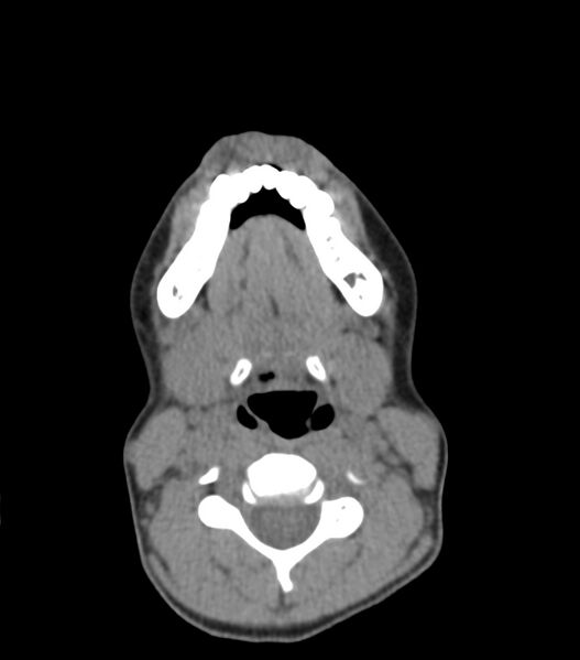 File:Nasoorbitoethmoid fracture (Radiopaedia 90044-107205 Axial non-contrast 50).jpg