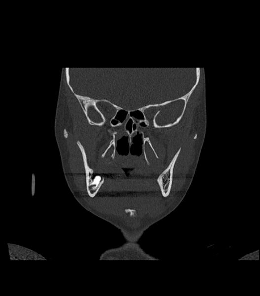 File:Nasoorbitoethmoid fracture (Radiopaedia 90044-107205 Coronal bone window 65).jpg
