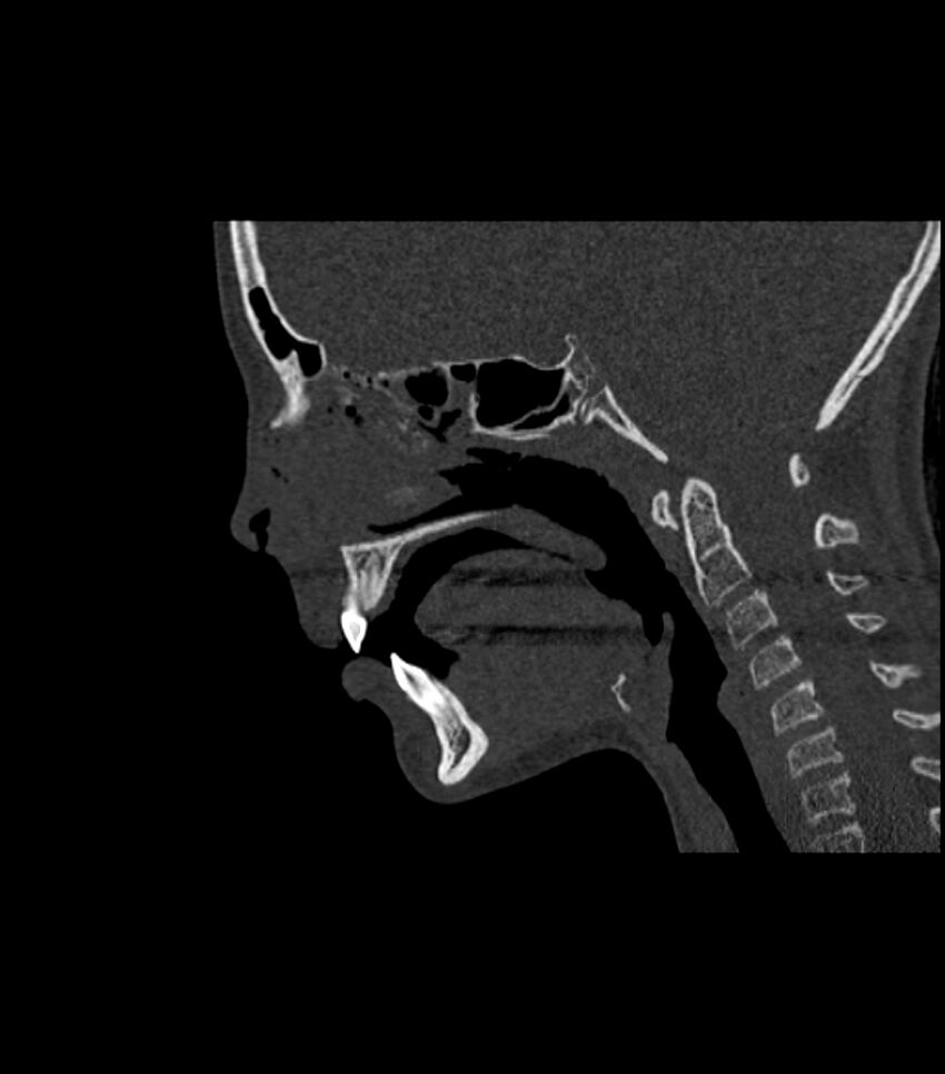 Nasoorbitoethmoid fracture (Radiopaedia 90044-107205 Sagittal bone window 71).jpg