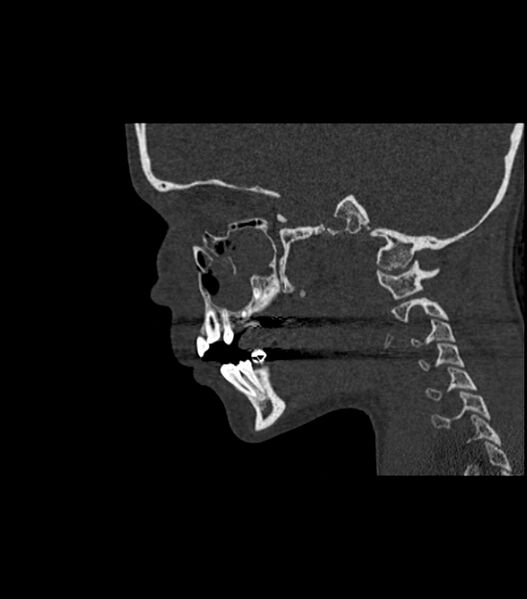 File:Nasoorbitoethmoid fracture (Radiopaedia 90044-107205 Sagittal bone window 90).jpg