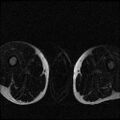 Necrotizing epididymo-orchitis with intra-testicular abscess (Radiopaedia 29397-29860 Axial T2 fat sat 20).jpg